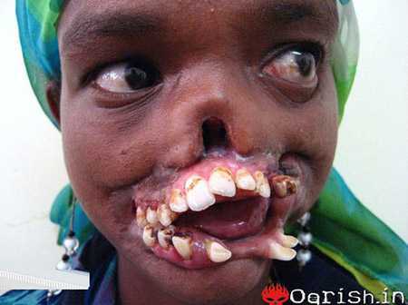 Môi, mũi cô bé châu Phi bị vi khuẩn 'ăn thịt'