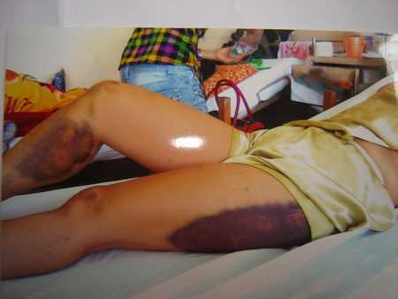 Một phụ nữ bị chích thanh sắt nung nóng vào mặt