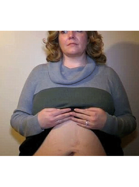 Phẫu thuật giảm béo, bác sĩ cắt nhầm cả ruột