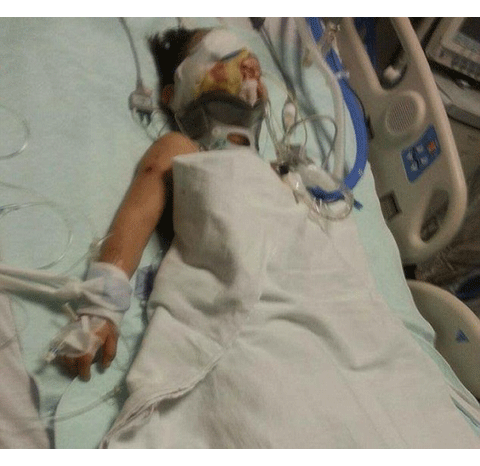 Cậu bé bị chó tấn công, mặt biến dạng