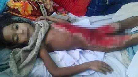 Nướng ngô, bé 6 tuổi bị thiêu cháy toàn thân