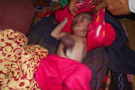 Bé trai sơ sinh có trái tim nằm ngoài lồng ngực