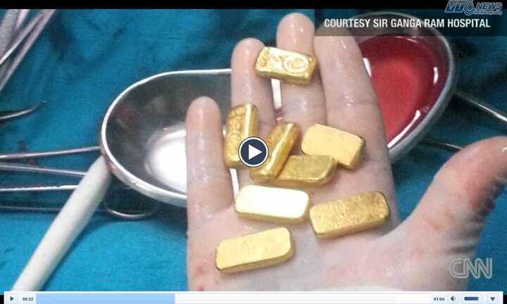 Clip: Tìm thấy 12 thỏi vàng trong bụng một doanh nhân