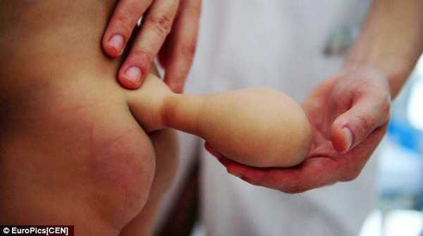 Bà mẹ cầu xin bác sỹ “cắt đuôi” cho con