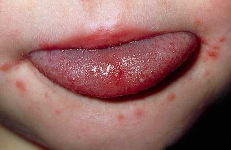 Thủ tướng ra công điện chống dịch bệnh tay chân miệng