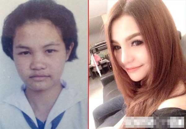 Bị chê xấu, nữ sinh phẫu thuật thành hot girl