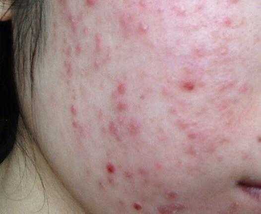 Tàn phá dung nhan vì ham mỹ phẩm 'xịn' giá bèo