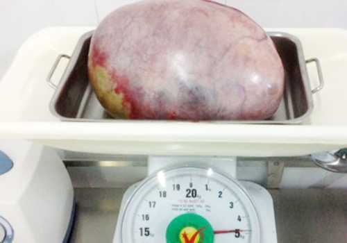 Khối u như quả dừa trong bụng thiếu nữ