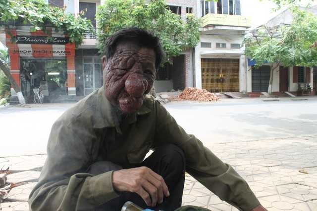 Nỗi đau của người 40 năm mang khuôn mặt ‘quỷ dữ’