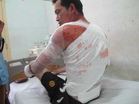 Lò thép nổ tung như pháo hoa: 2 người nhập viện đã tử vong