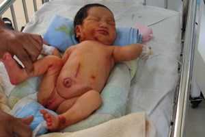 Bé gái sơ sinh bị bỏ rơi, giòi bám đầy người