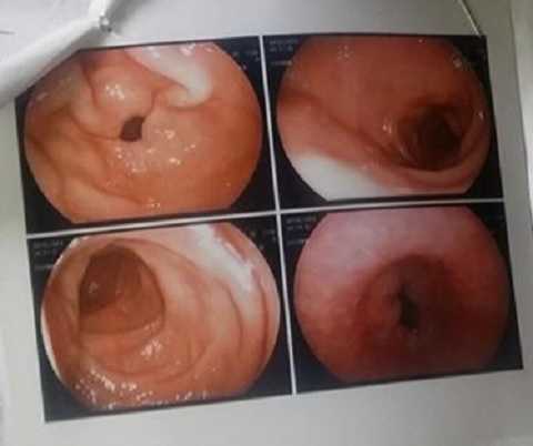 Khỏi viêm loét, loạn sản dạ dày sau gần 20 năm