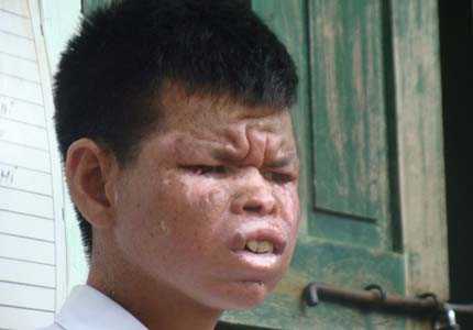 Video: Những người mắc bệnh 'quỷ ám' ở Mường Chiềng