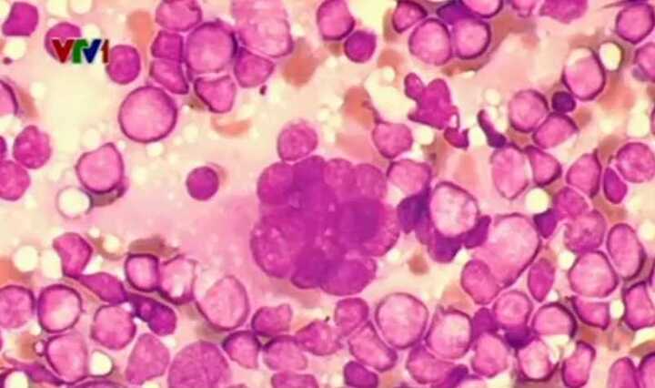 Phép nhiệm màu chữa khỏi căn bệnh thế kỷ HIV đã biến mất