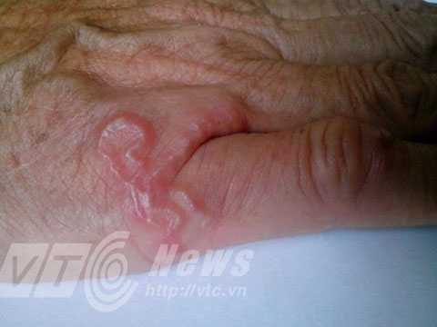 Kinh hãi giun xâm nhập cơ thể, sống lúc nhúc dưới da