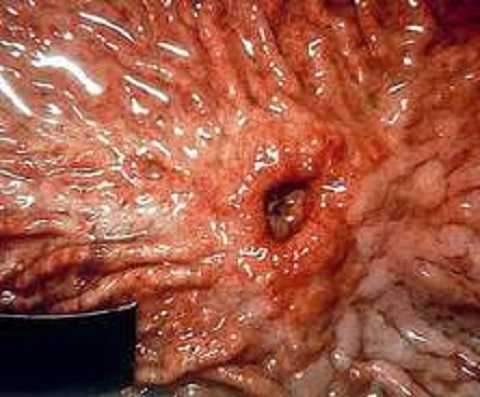 Người trẻ thế này đã thủng dạ dày