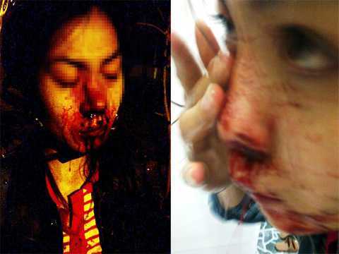 Chạy trốn CSGT, vợ ngồi sau xe vỡ mũi