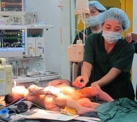 Tách cặp song sinh dính liền bụng