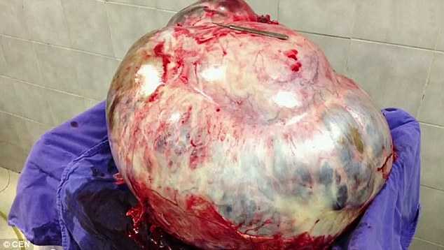 'Khó có thể tìm thấy khối u to hơn thế'