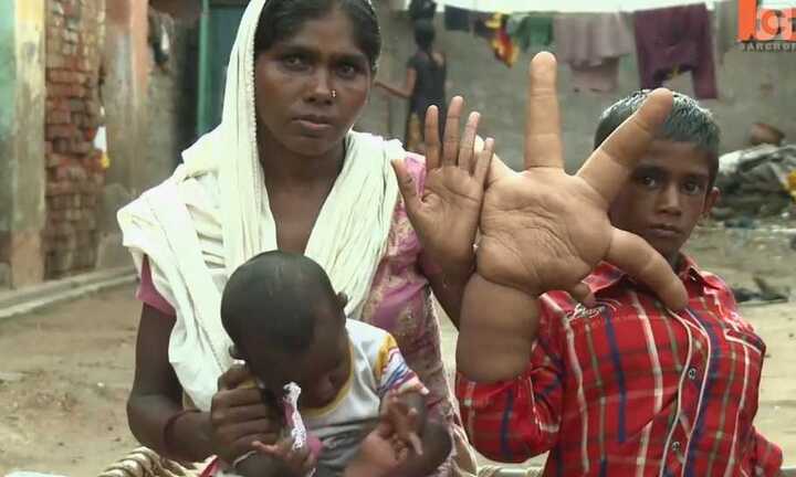 Kì lạ bé trai có bàn tay khổng lồ nặng 8kg