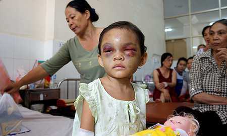 Bé 4 tuổi bị bạo hành: Ai được quyền nuôi dưỡng?