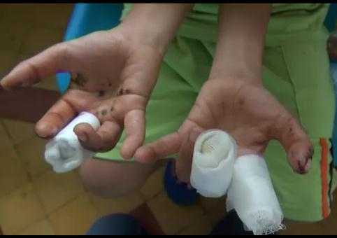 Clip: Đồ chơi Trung Quốc phát nổ, bé trai đứt tay, mắt hỏng nặng