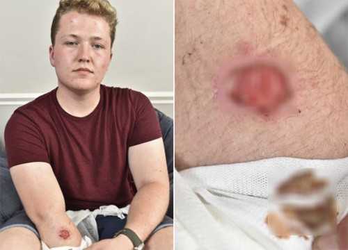 iPhone 5 nóng bất thường gây bỏng cho người dùng