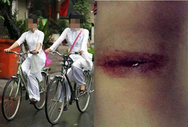 Nữ sinh Đồng Nai lại bị kẻ lạ rạch mông