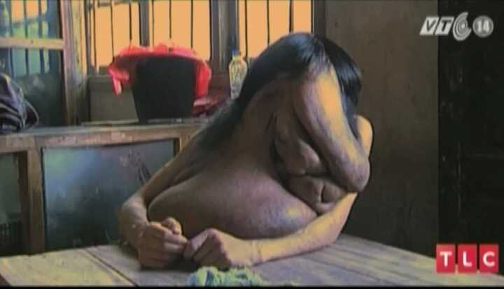 Người 'mặt voi' và giấc mơ trở thành người bình thường