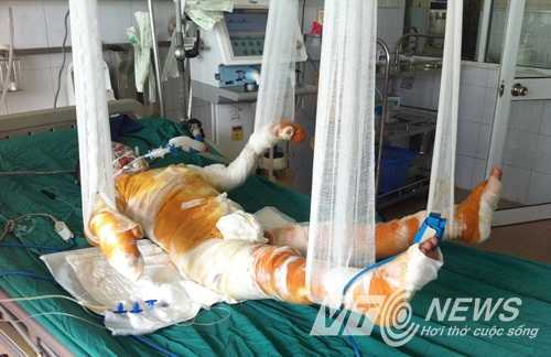 Xót xa cả gia đình bốc cháy nằm trên giường bệnh