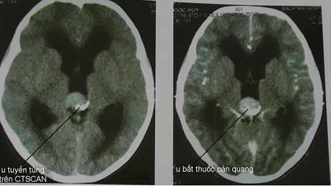 U tuyến tùng, cẩn thận nhầm bệnh tiêu hóa mà tử vong