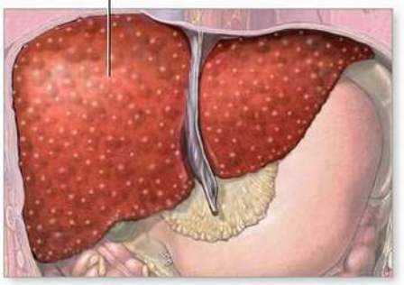 Bài thuốc dân gian cực hay trị bệnh viêm gan