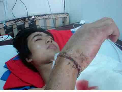 Nối thành công bàn tay đứt lìa