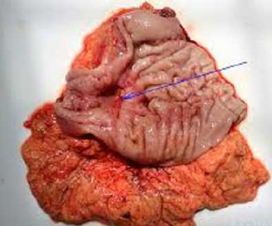 Tự cứu mình trước nguy cơ ung thư