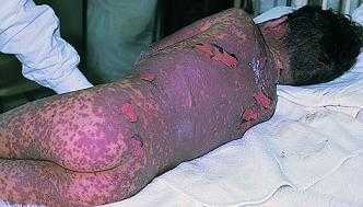 Tự ý mua thuốc uống khi ho, nguy hiểm tính mạng thế nào?