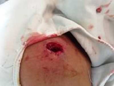 Cây đâm thủng mặt bé trai