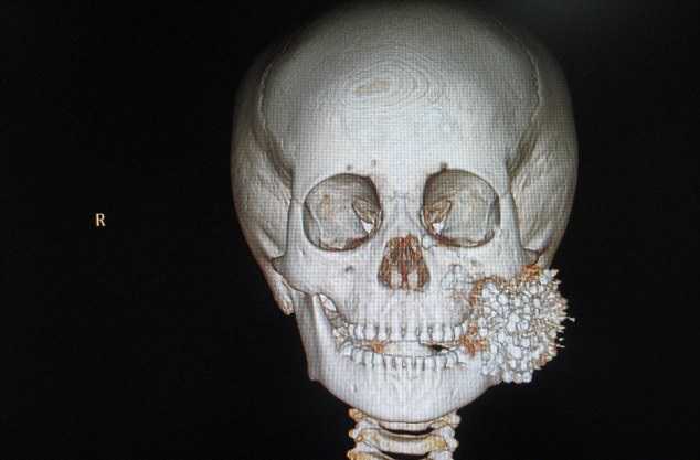 Bị găm hơn 300 viên đạn vào mặt, cậu bé Trung Quốc vẫn sống sót