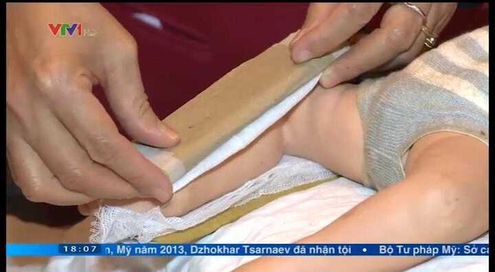 Cách xử trí khi trẻ bị gãy xương