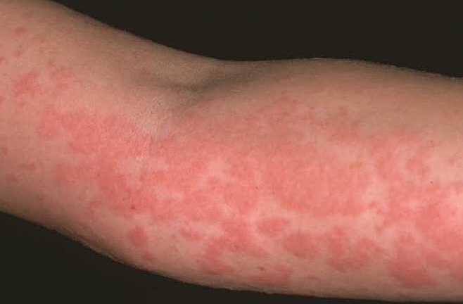 Đối phó với bệnh nổi mề đay khi trời lạnh