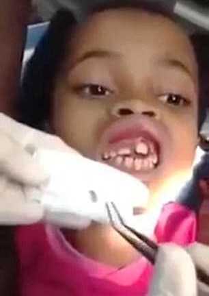 Ghê người giòi nhung nhúc trong lợi bé gái