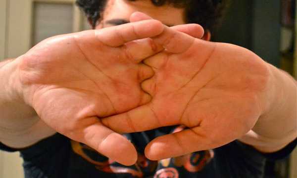 Mối nguy hại 'chết người' từ thói quen bẻ đốt ngón tay