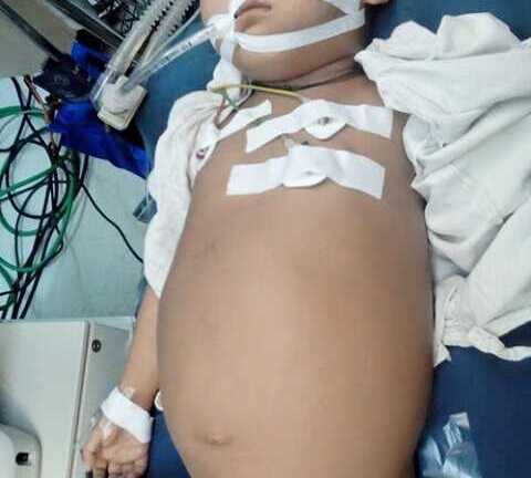 Cắt thành công khối u khổng lồ ở ống mật