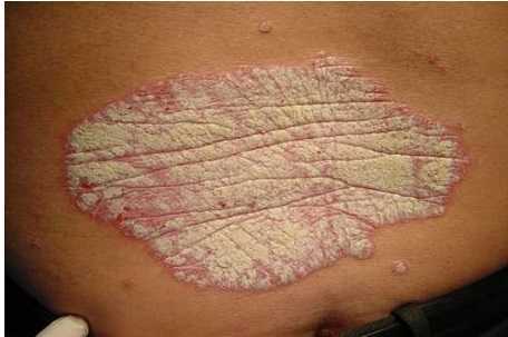 Chuyên gia nói về bệnh vảy nến