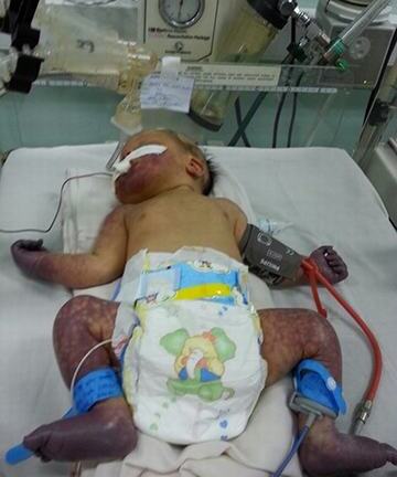 Căn bệnh nhiễm trùng máu, hoại tử tay chân dẫn đến tử vong