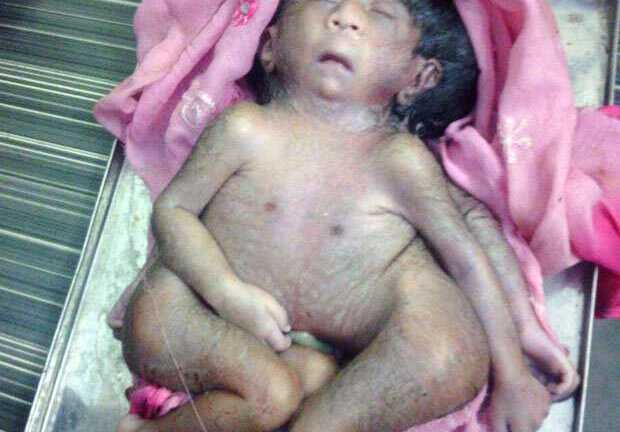 Kì lạ em bé có 4 chân, 4 tay được tôn thờ như thần Hindu