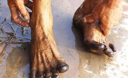 Kỳ lạ hiện tượng chân bị đen thui ở TP.HCM