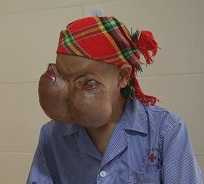 Hình dạng mới của người phụ nữ có đôi mắt sắp nổ tung