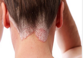 8 vị trí dễ mắc ung thư da mà bạn không ngờ tới