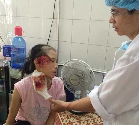 Xin cứu giúp người đàn bà góa bụa ung thư sắp phải khoét xương đầu
