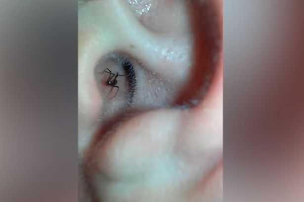 Video: Kinh hãi phát hiện nhện góa phụ đen sống trong tai người